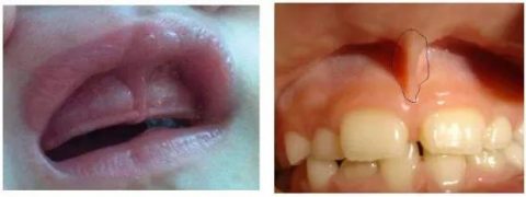 唇系带过低门牙缝隙偏大图片