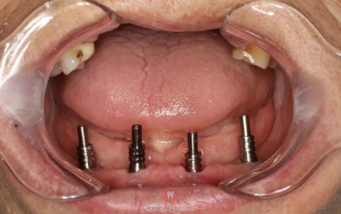 **口腔科张建兴72岁老人种牙记