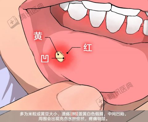 口腔溃疡会变成口腔癌吗？