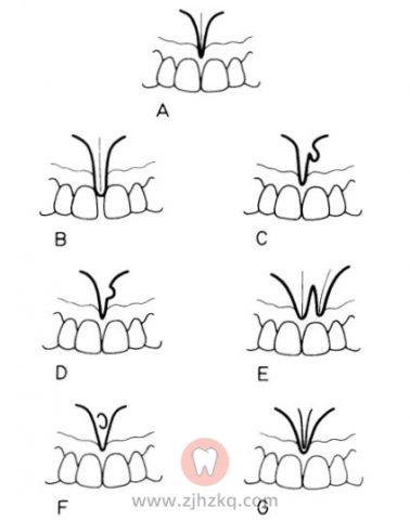 唇系带过低门牙缝隙偏大图片