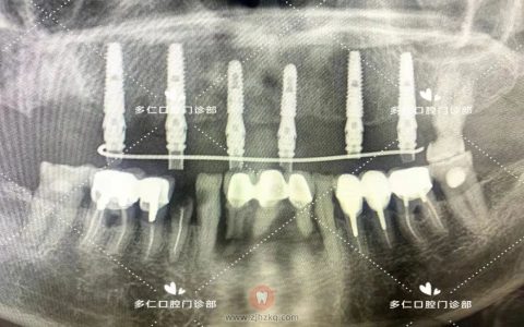 杭州多仁口腔半口即拔即种即刻修复案例
