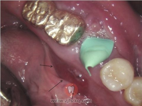 种植牙周围发生恶性肿瘤癌症的两个病例及分析