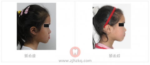 地包天（反颌）照片图片