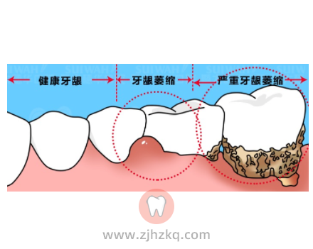 牙龈萎缩可以做种植牙吗？