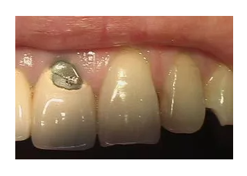 烤瓷牙崩瓷原因整理