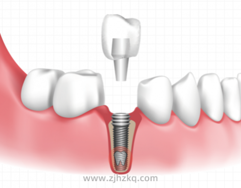 拔牙多久后可以做种植牙