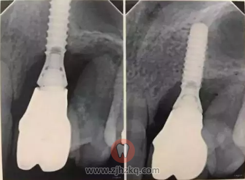 种牙会不会失败危害有哪些