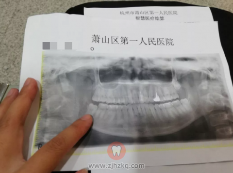 萧山姑娘**医院拔智齿拔牙记