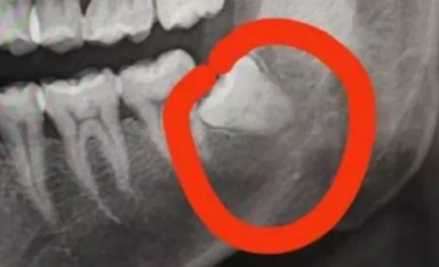 杭州网友拔智齿价格一颗2000元还要签手术协议