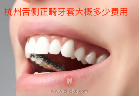 杭州舌侧正畸牙套大概要花多少费用