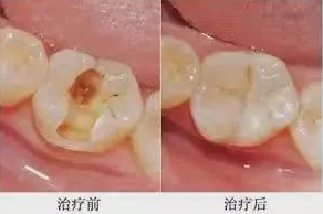 补牙后需要注意什么