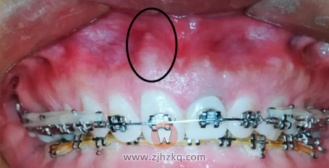 有些医生未必会告诉你的箍牙危害