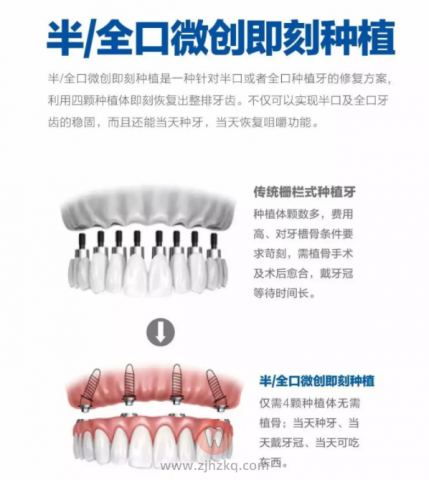 多颗牙缺失是否可以做种植牙