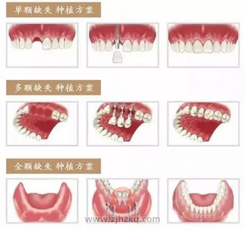 多颗牙缺失是否可以做种植牙