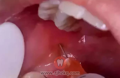 拔牙打麻药伤大脑吗对大脑有影响吗