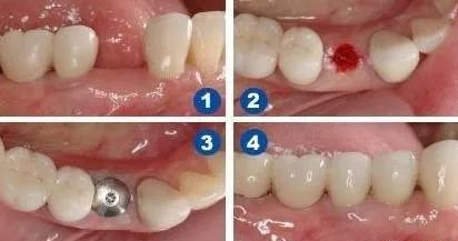 夏天不适合做种植牙