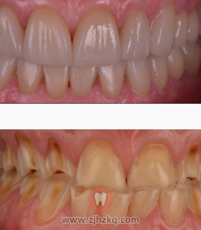 酸蚀症牙齿图片