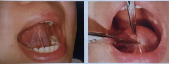 杭州舌系带手术科普