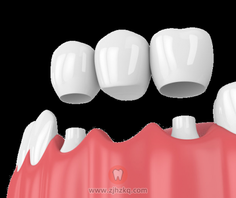 杭州医院选择哪种假牙比较好