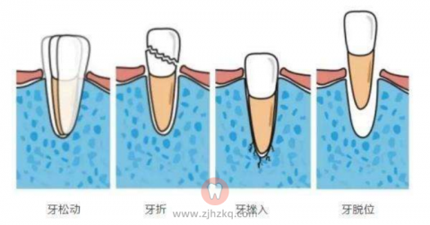 运动牙套真的能保护牙齿吗