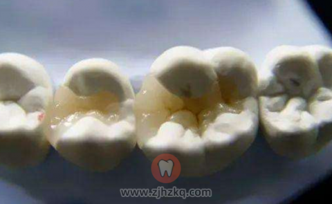 为什么补牙价格相差那么大