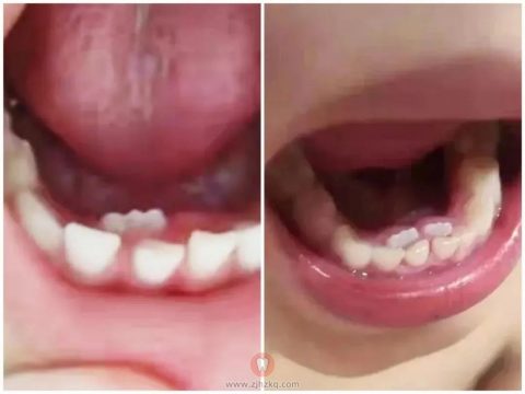 儿童双排牙照片图片