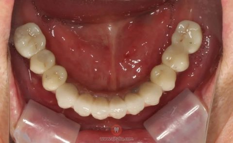 **口腔科张建兴72岁老人种牙记