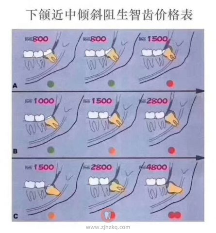 杭州拔智齿收费差别太大了