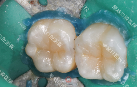 龋齿补牙治疗过程图片