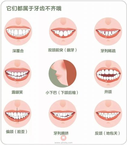 什么样的牙齿需要矫正附牙齿照片对比图