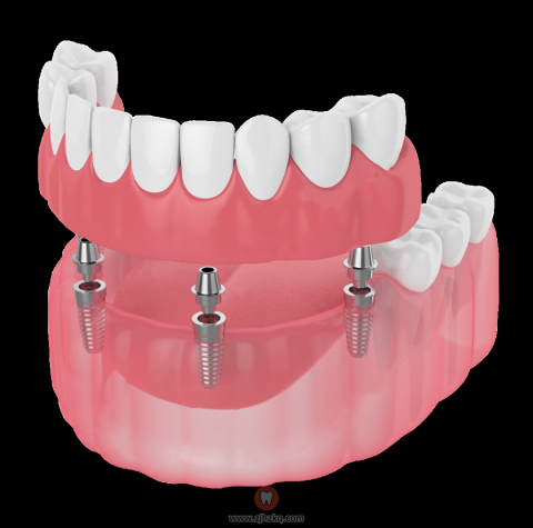 杭州医院选择哪种假牙比较好