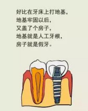 为什么种牙前要先治疗牙周炎