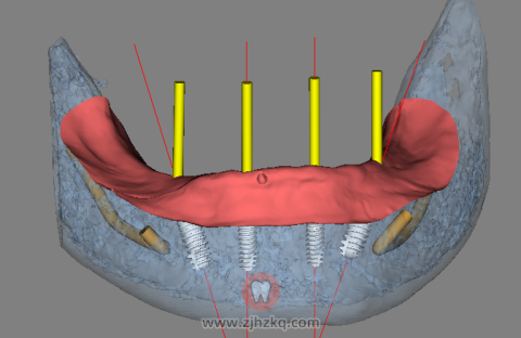 **口腔科张建兴72岁老人种牙记