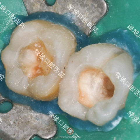龋齿补牙治疗过程图片