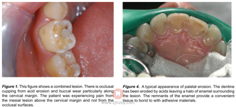 酸蚀症牙齿图片