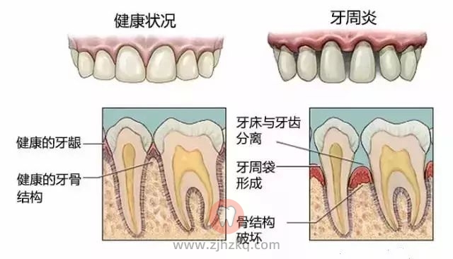 塞牙怎么办一般牙科怎么处理