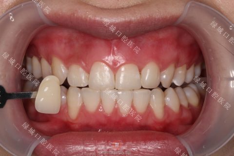 杭州绿城牙医教你如何美白牙齿