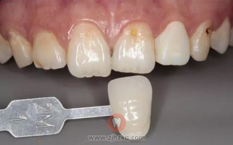 杭州做牙齿贴面好还是烤瓷牙好