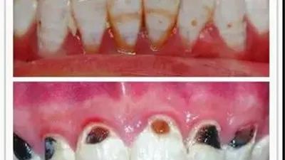碳酸饮料对牙齿危害照片图片