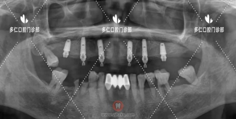 杭州多仁口腔无痛微创半口种植牙看牙记