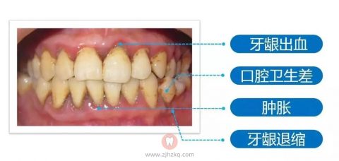 什么人容易得牙周病