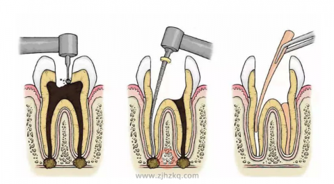 根管治疗完成后牙就死掉了吗