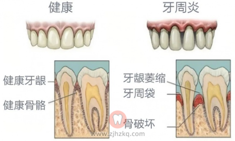 牙周炎牙齿健康牙齿对比图