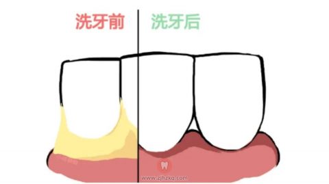 洗牙真的有必要吗