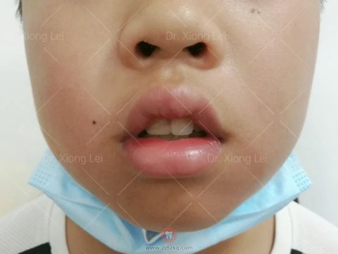 怎样确认孩子有没有口呼吸附腺样体面容图