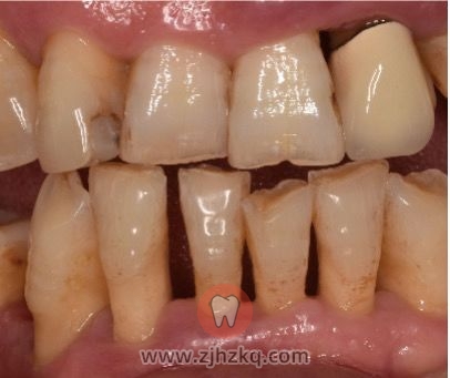 艾维口腔吕佩红洗牙科普好文