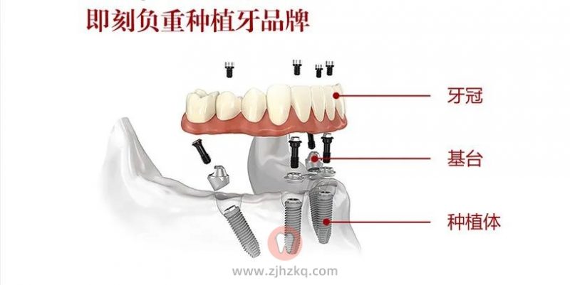 杭州多仁口腔无痛微创半口种植牙看牙记