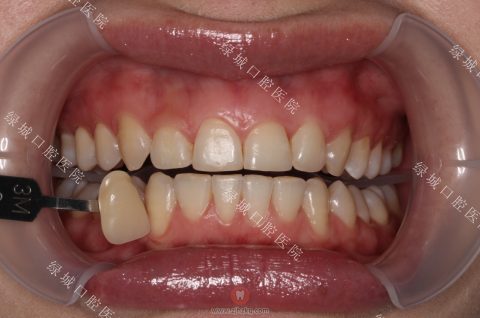 杭州绿城牙医教你如何美白牙齿