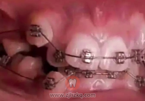 最适合正畸治疗的年龄是几岁