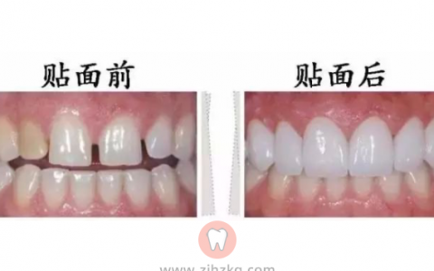 杭州牙贴面:让笑容更加自信